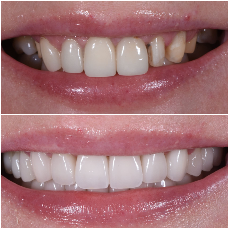 Cosmetic Bonding