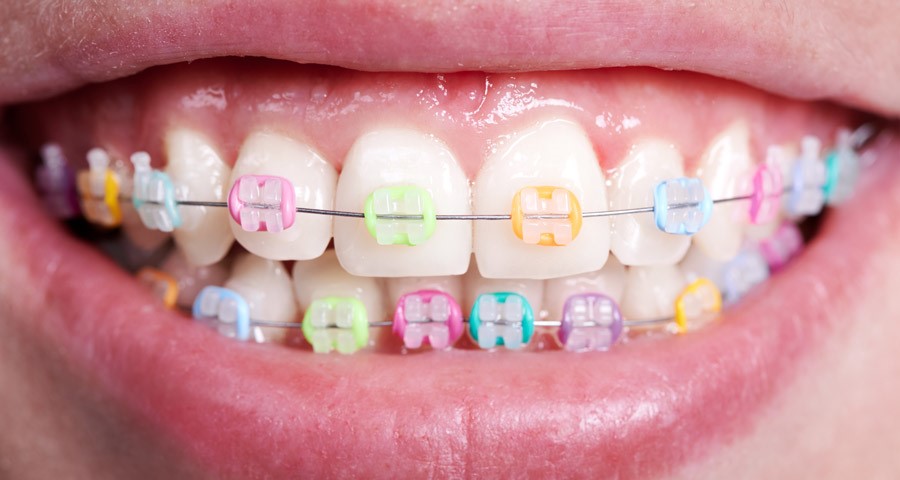 Orthodontic Treatment