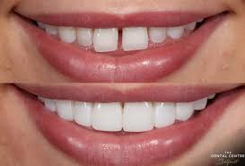 Veneers