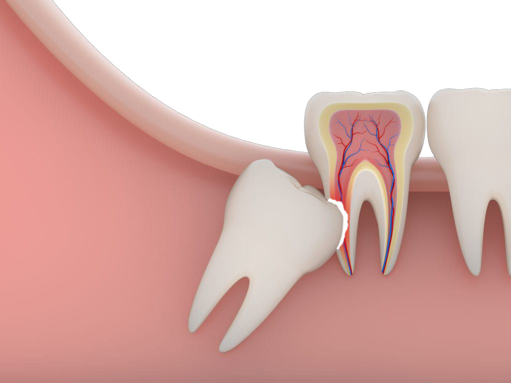 Wisdom Tooth Removal